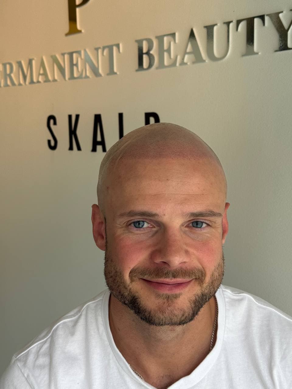 Kunde etter skalpmikropigmentering sett forfra